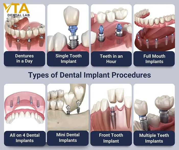 dental-implants-cost-2